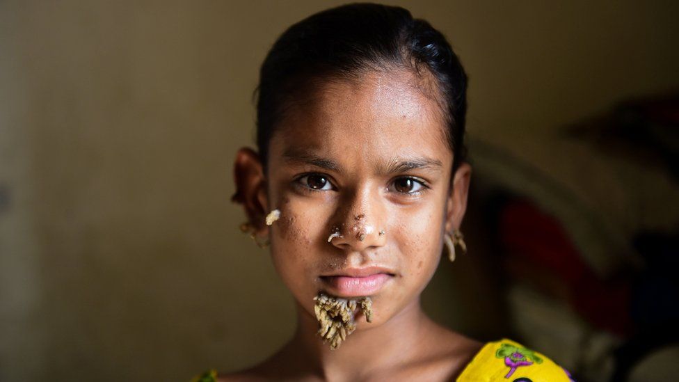 Sahana Khatun pictured in Dhaka with warts on her face (31 January 2017)