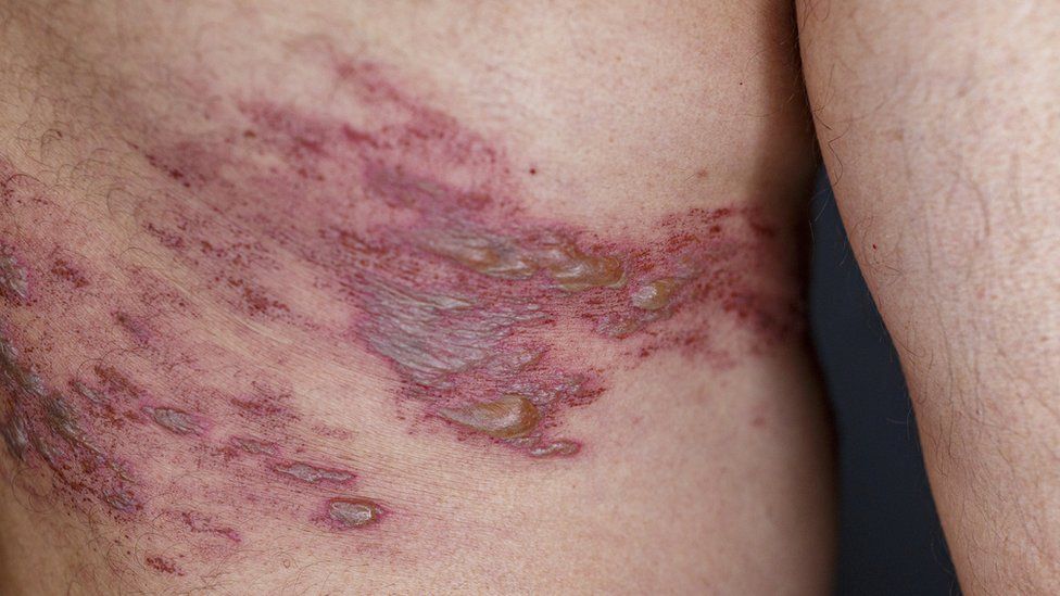 Shingles can create a painful skin rash on the body