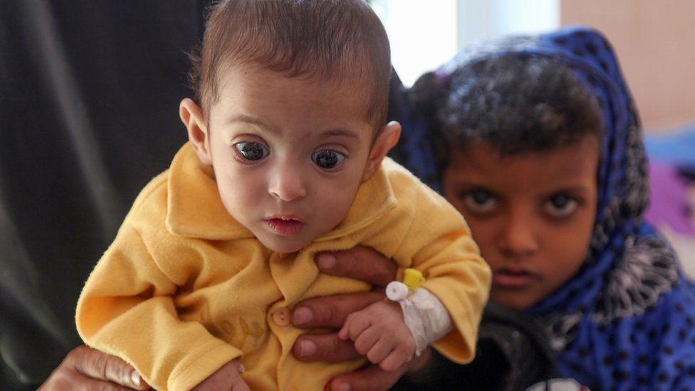 A child suffering from malnutrition in war-ravaged Yemen, 21 November