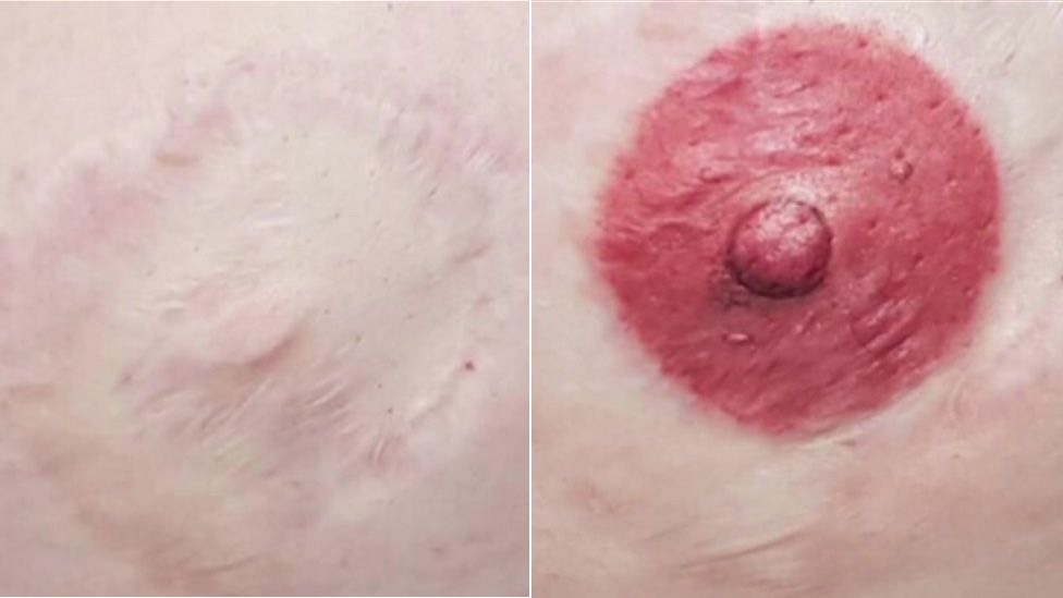 Before and after pictures on nipple