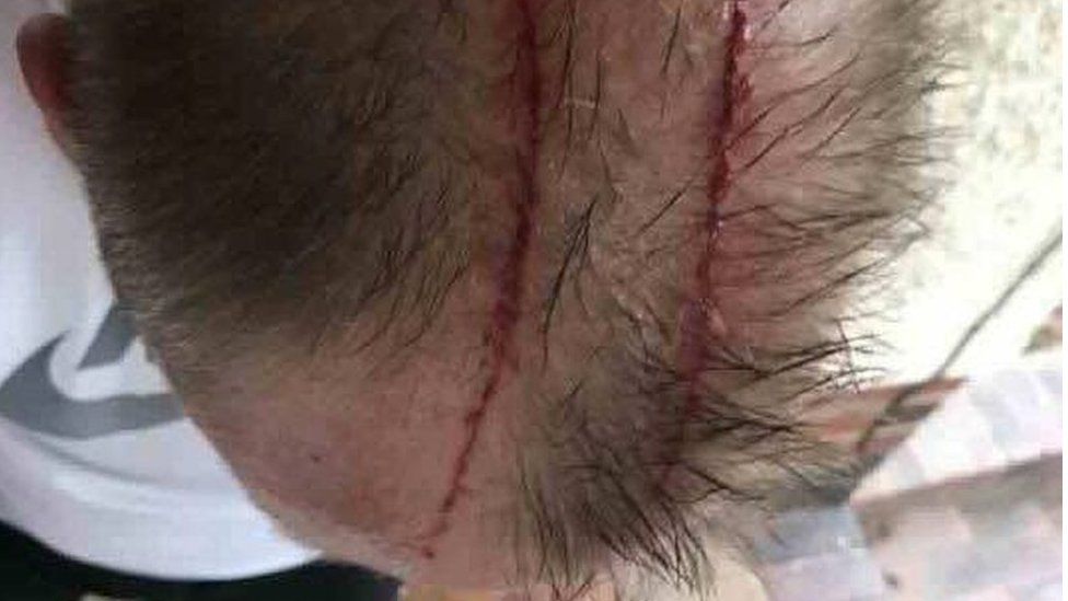 Top of man's head after bird attack