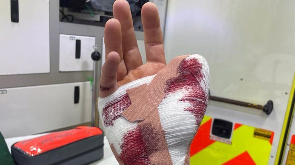Mr Jenkinson's bloodied and bandaged hand, showing the remaining four fingers
