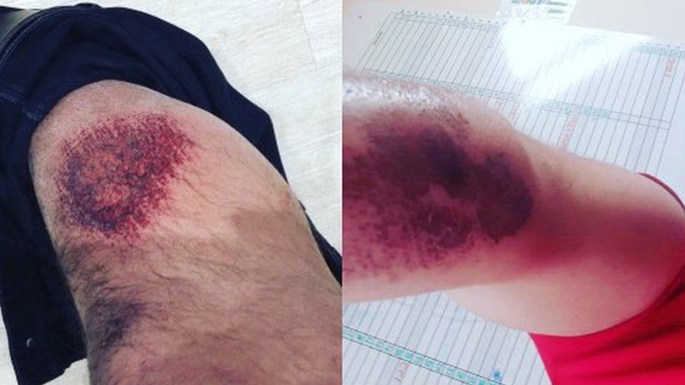 Rugby players' burns from 3G pitch