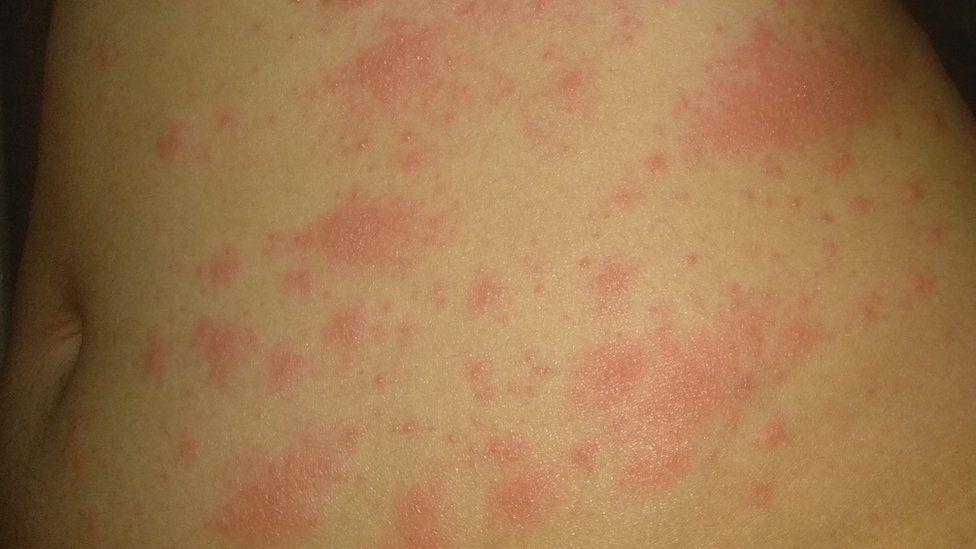 Can covid cause rash in toddlers