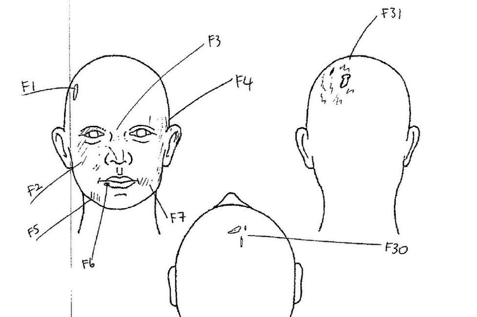 Body map showing Tara Newbold's head injuries