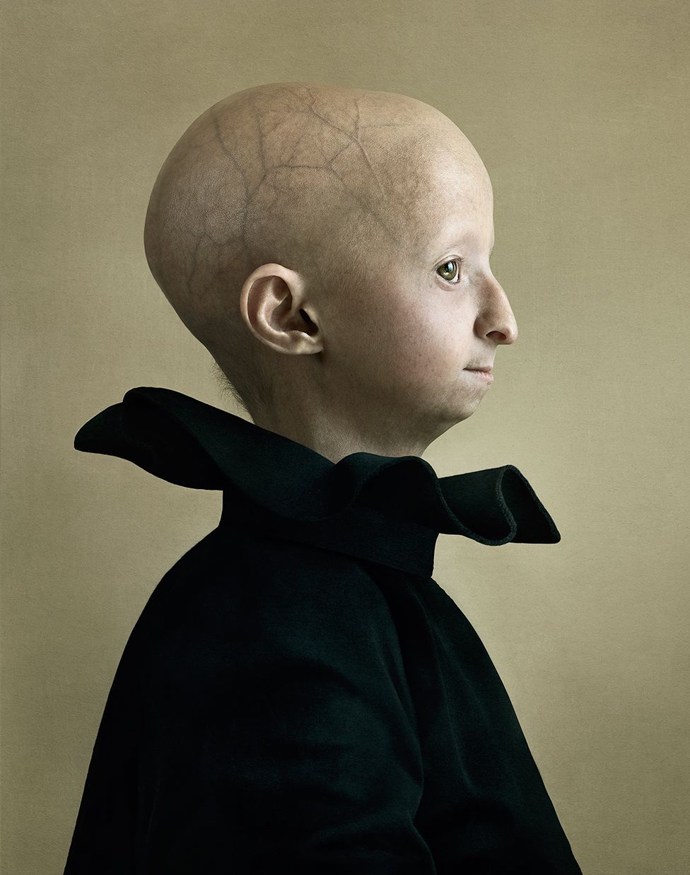 A child with progeria, a rare medical condition, poses for a portrait