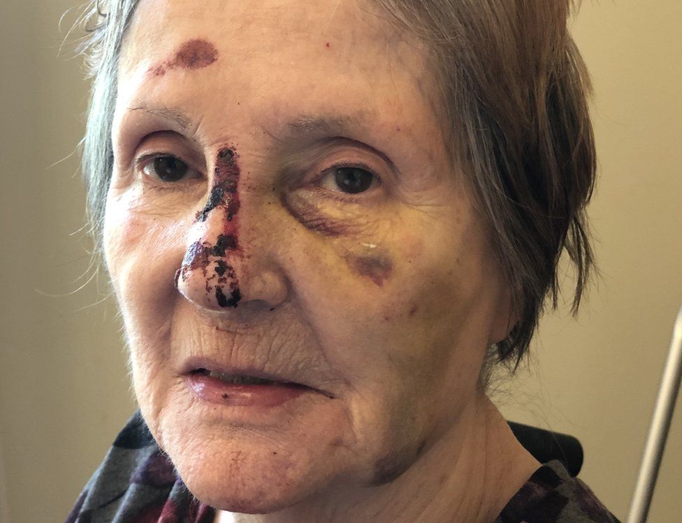 Sandra pictured with cuts and bruising to the face following a fall