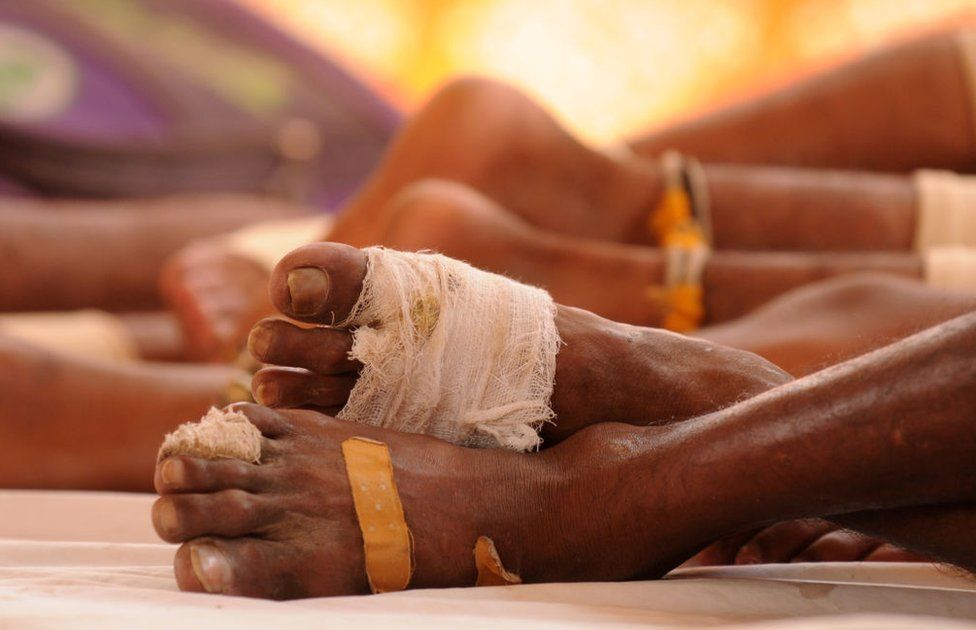 Bruised feet of Kawariyas wrapped in bandages seen as they rest during the journey on 7 August 2018 in Gurugram, India.