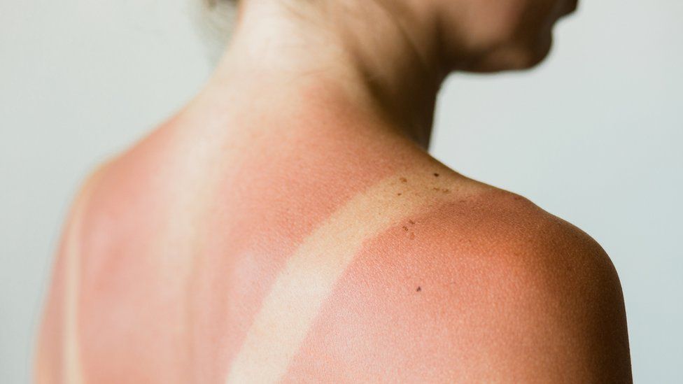 Woman with sunburn on her back - stock photo