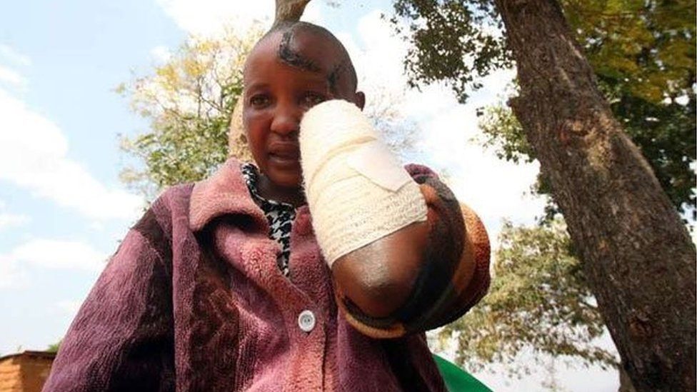 Kenyan woman with hacked hand