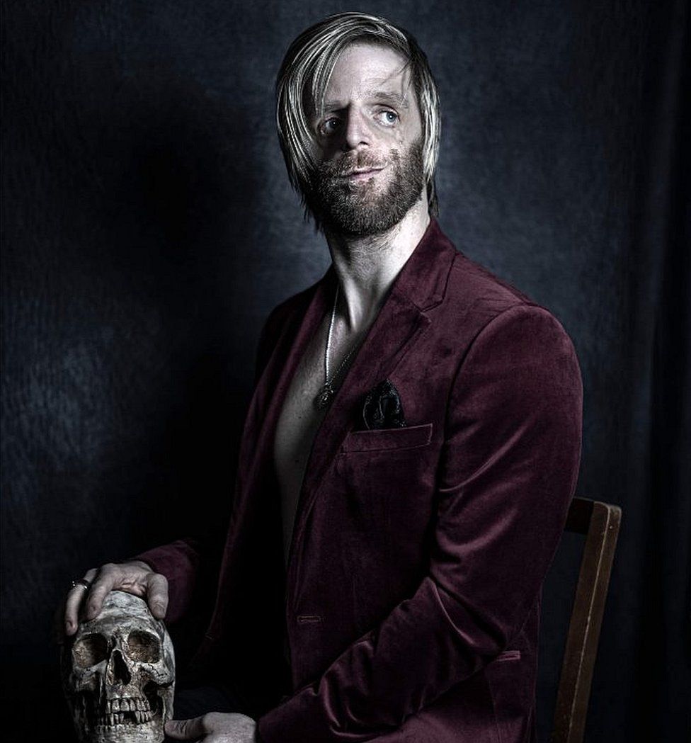 A man with a condition affecting the stricture of his face poses with a skull