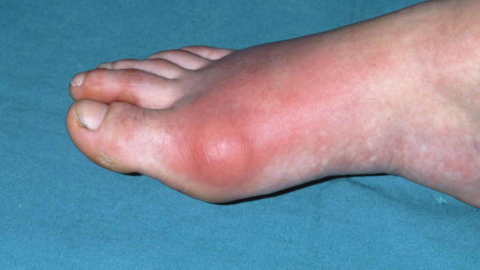 Inflammation of the joints in the foot in gout