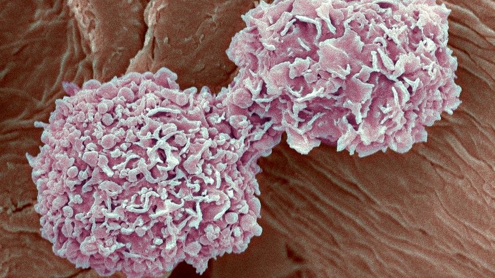 breast cancer cells