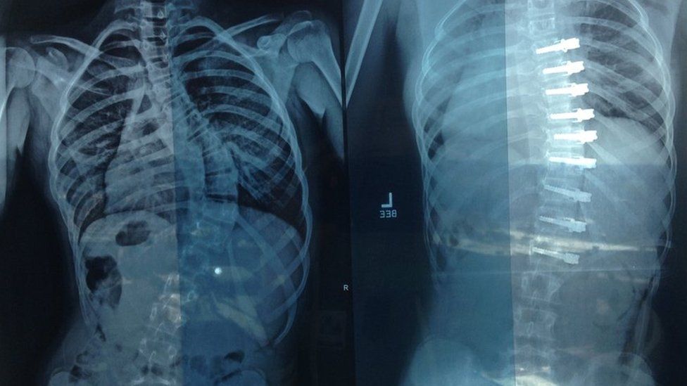 The x-rays show a spine before (left) and after (right) the operation