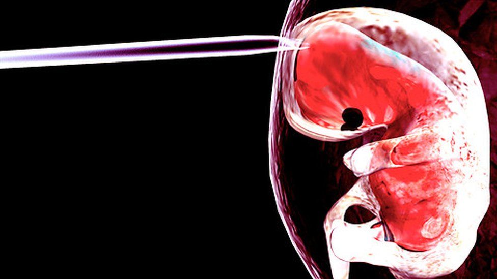 'Pregnancy fluid' reverses ageing bones BBC News