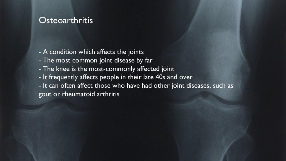 An x-ray of two knees with some facts about osteoarthritis