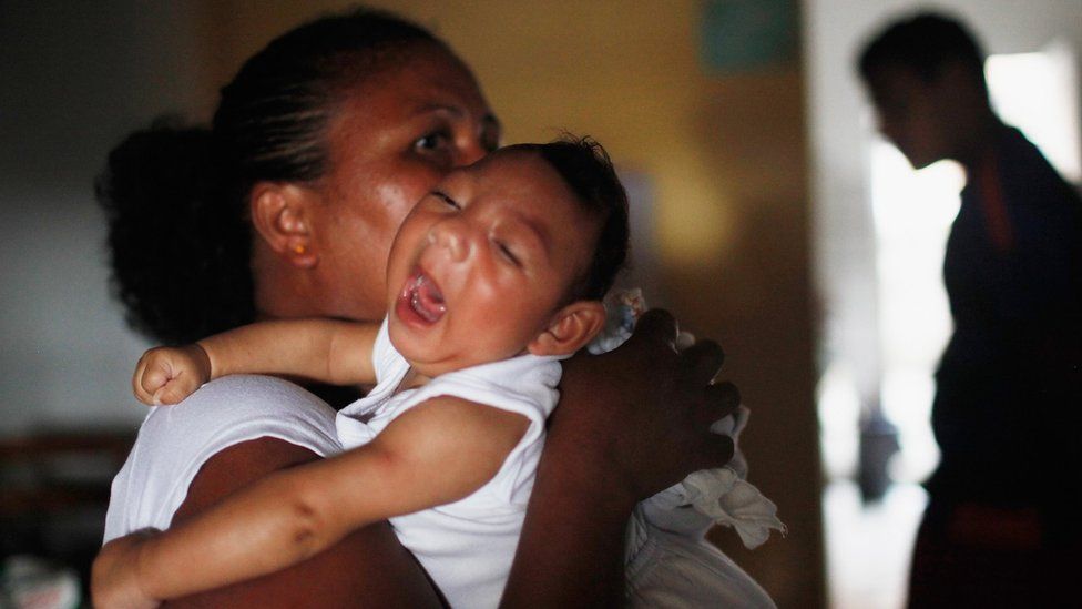 Baby with microcephaly