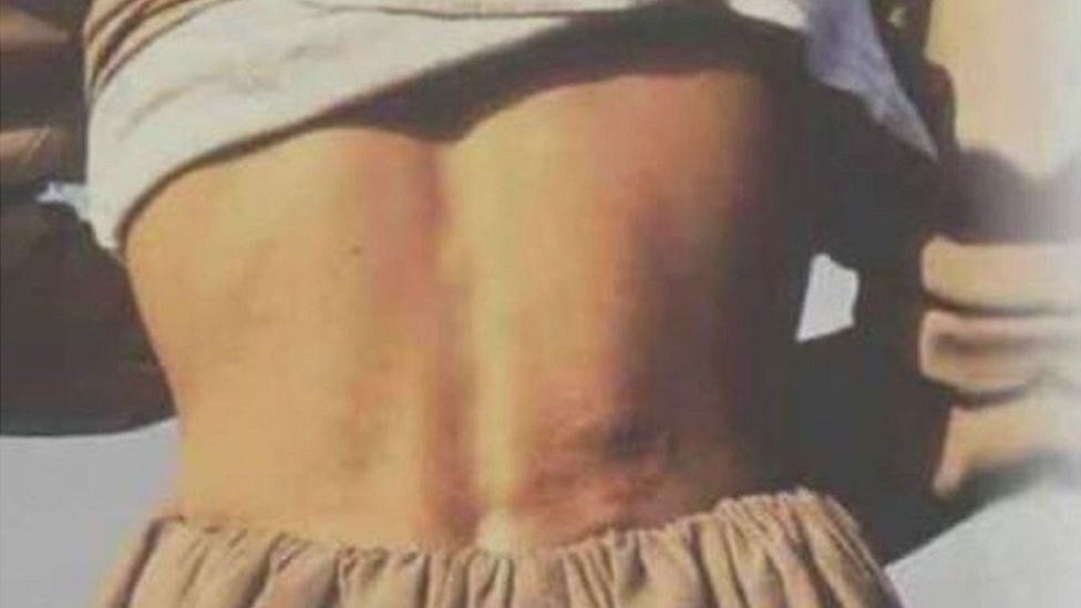 Taimour Abdulla Ahmed shows the bullet marks on his back