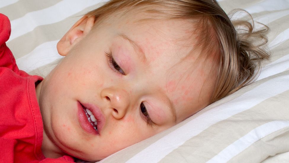 Child in bed with scarlet fever