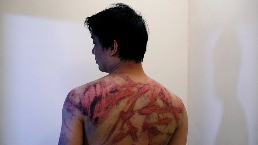 Calvin So, a victim of Sunday's Yuen Long attacks, shows his wounds at a hospital, in Hong Kong, China July 22, 2019