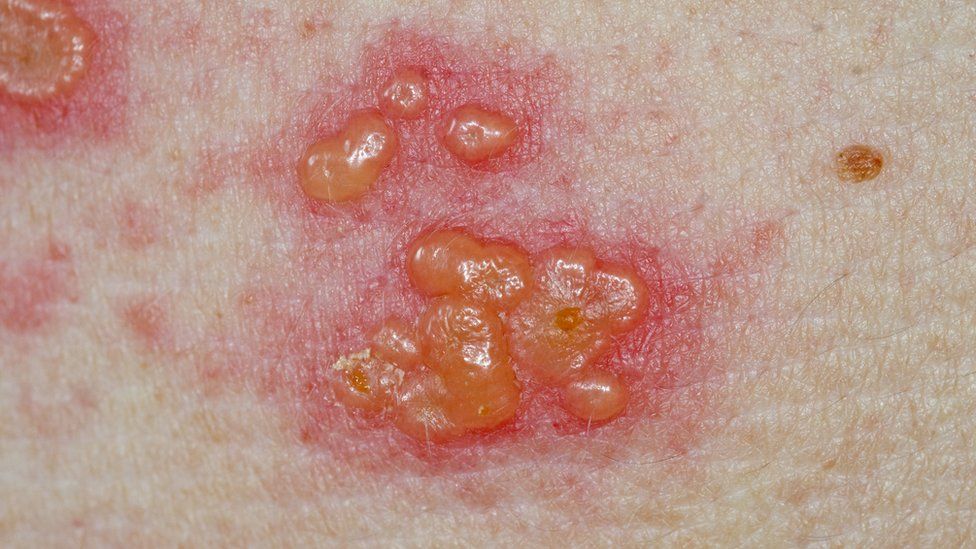 Image of Shingles which includes blotchy, blisters.