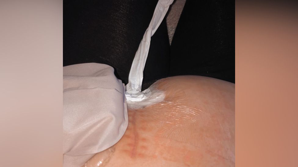 Farrah Moseley-Brown's stoma scar