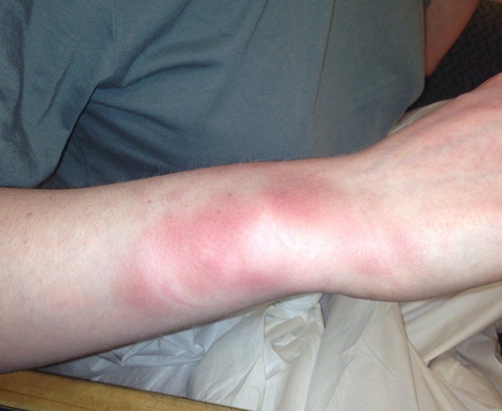 Koshka Duff's bruised arm
