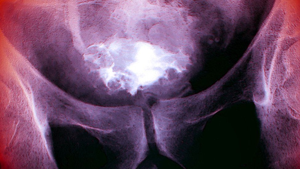 X-ray of bladder cancer