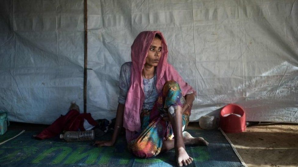 A Rohingya Muslim refugee Nosuba Khatun (40) shows the bullet wound inflicted while fleeing from an attack by the Myanmar military at her shelter in the the Kutupalong refugee camp in Cox"s Bazar on December 4, 2017.