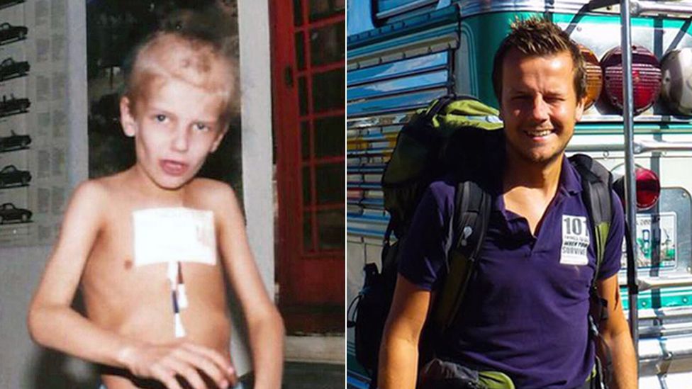 Two pictures of Greig Trout - one as a sick child and one as a healthy adult