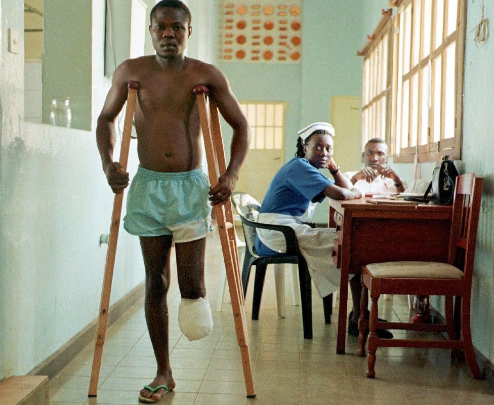 An amputee in hospital in Freetown, Sierra Leone in May 1998