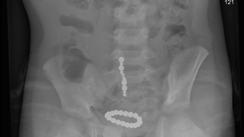 X-ray of magnets in a child's gut