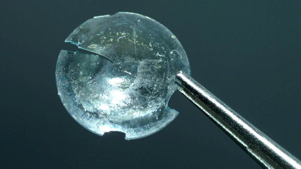 Contact lens that was lodged in woman's eye for 28 years