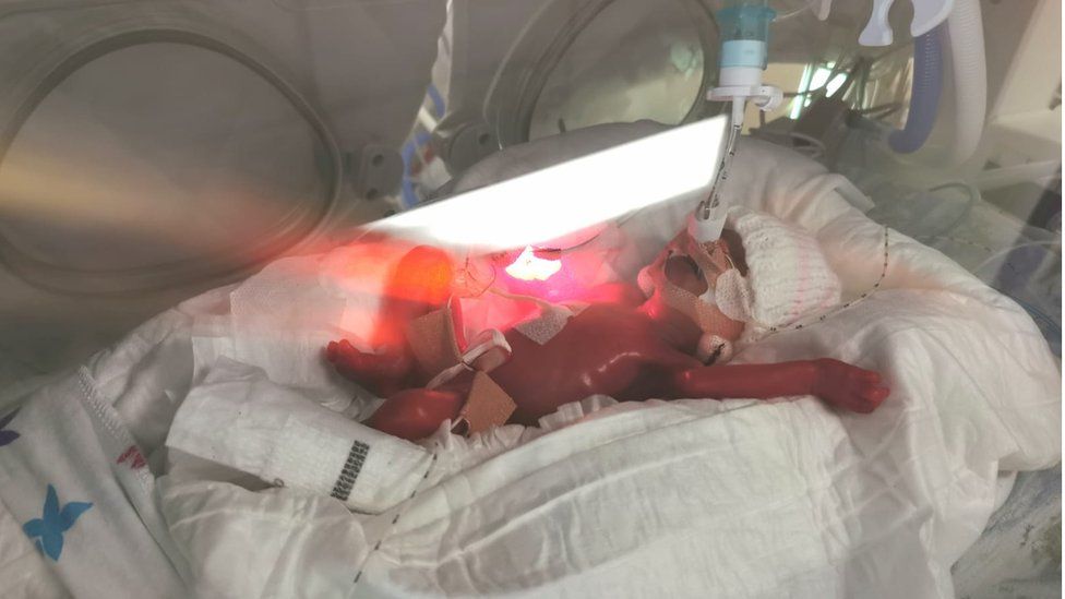 Airdrie Baby Born At 22 Weeks Finally Leaves Hospital c News