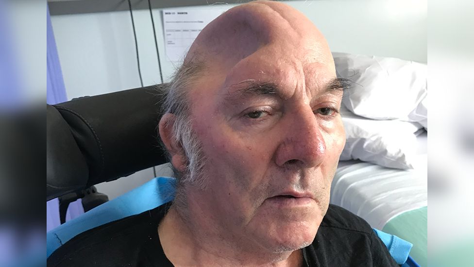 Roger Jones in hospital after having part of his skull removed, showing a deep indentation on the top of his head