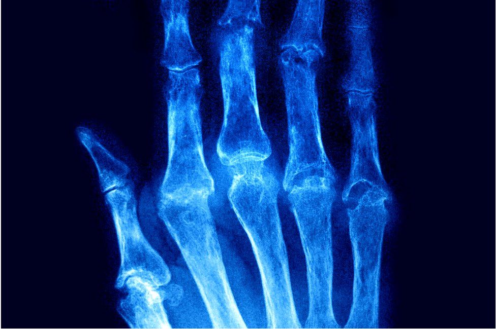X Ray of rheumatoid arthritis