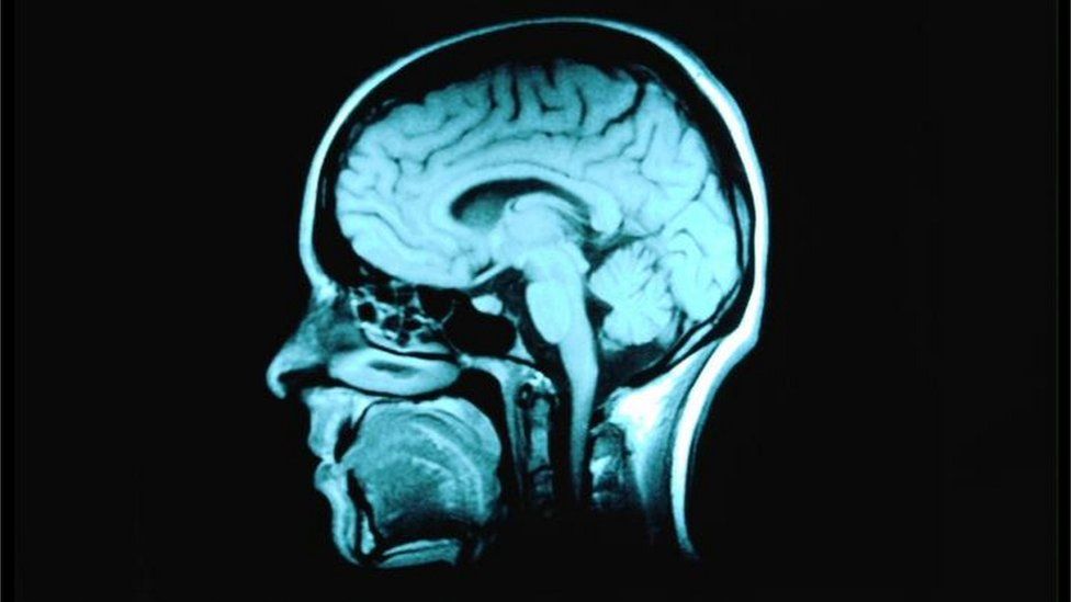 Brain scan