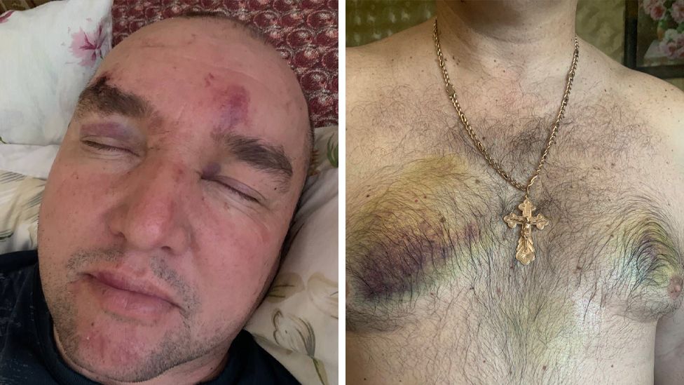 Two photos of Olexander showing bruises on his face and chest