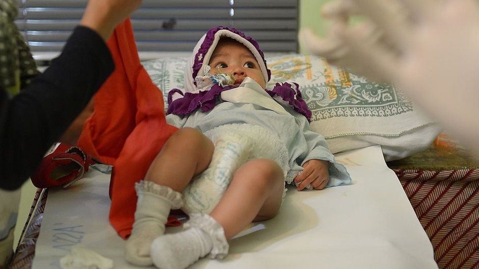 An Indonesian baby girl (C) lying on a bed as doctors prepare to perform her circumcision in Bandung. Indonesia,
