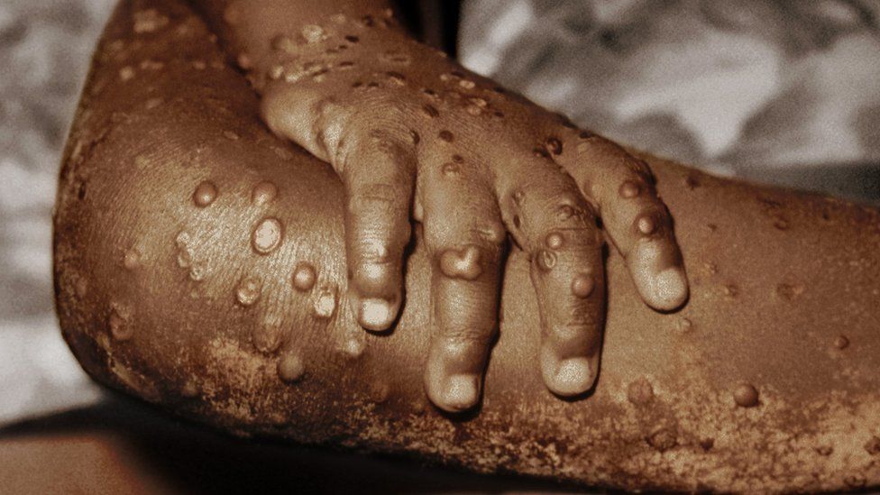 Child with monkeypox