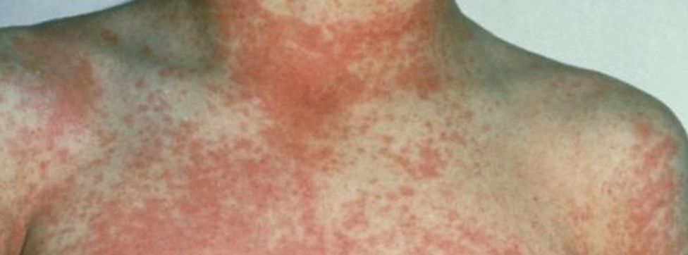 Rise In Scarlet Fever Cases Shows 49 Year High Health Experts Say    88697782 23486412 5a03 4670 A690 038e13d84f96 