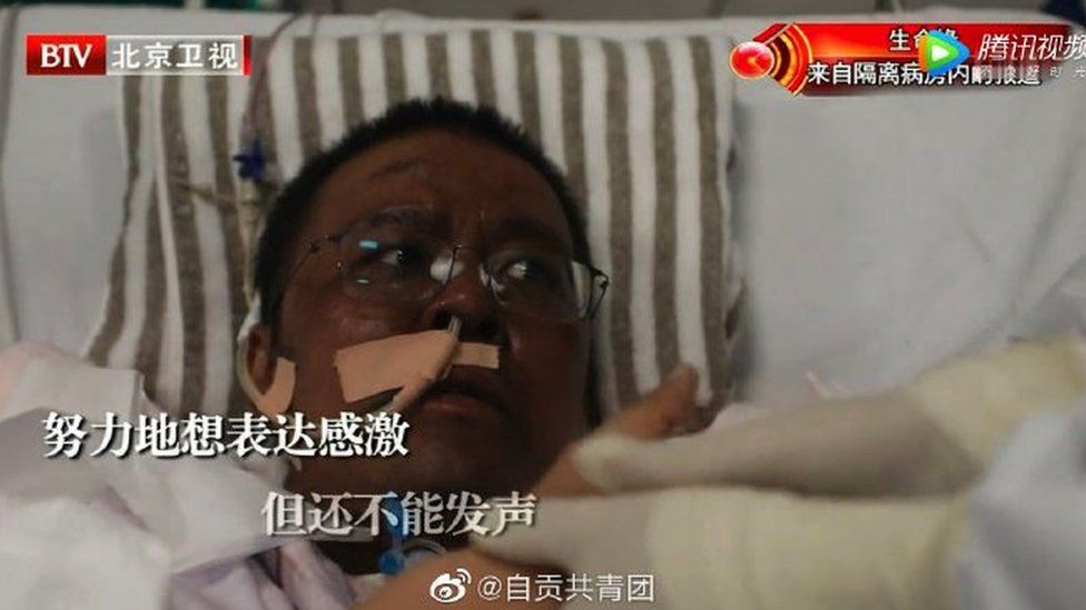 Dr Hu Weifeng after his skin changed colour