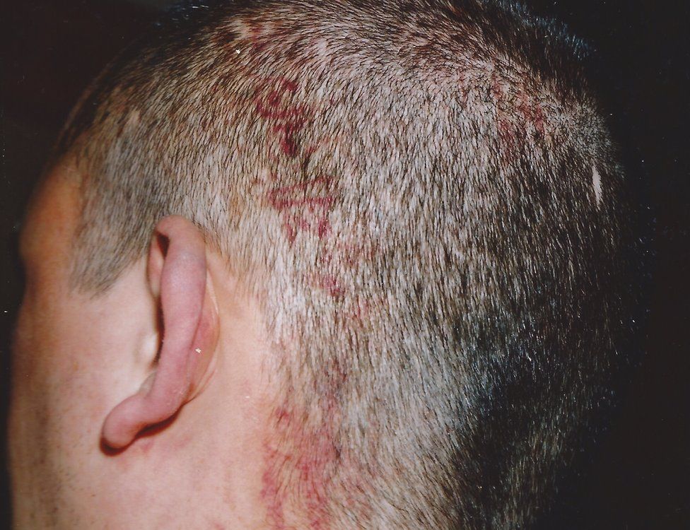 The imprint of a boot was left on Colin's head after he had been stamped on by his attackers