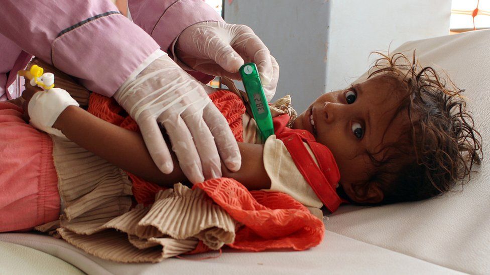A Yemeni child suspected of being infected with cholera is checked by a doctor