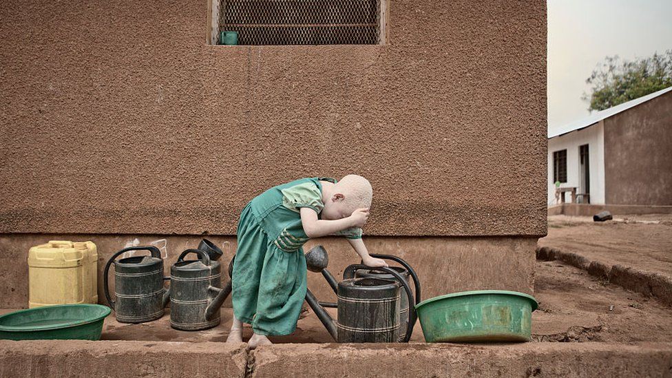 A young girl living with albinism pictured in 2012 in Tanzania.