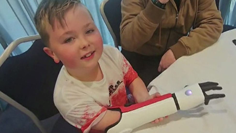 Alex, 7, is looking forward to riding a bike with his new bionic arm