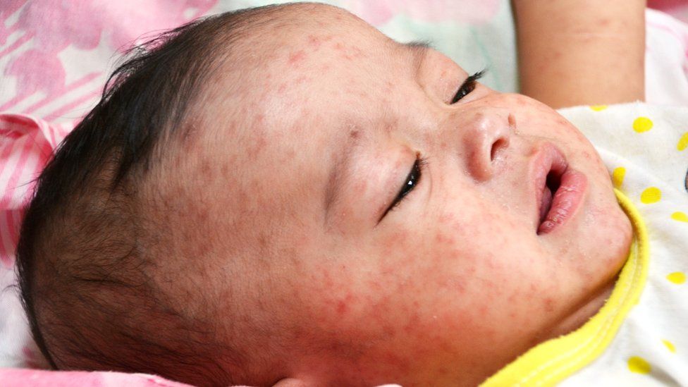 Baby with measles