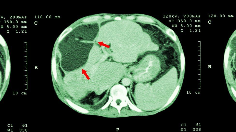 liver scan