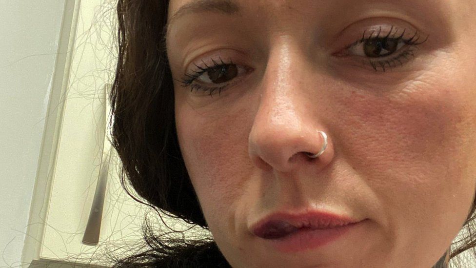 Photos of people with complications after lip filler surgery