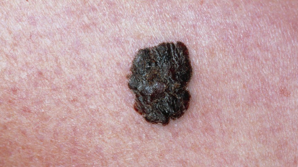 Mole on skin melanoma